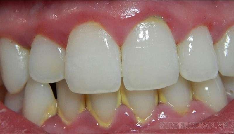 Bựa răng bám quanh vùng chân răng