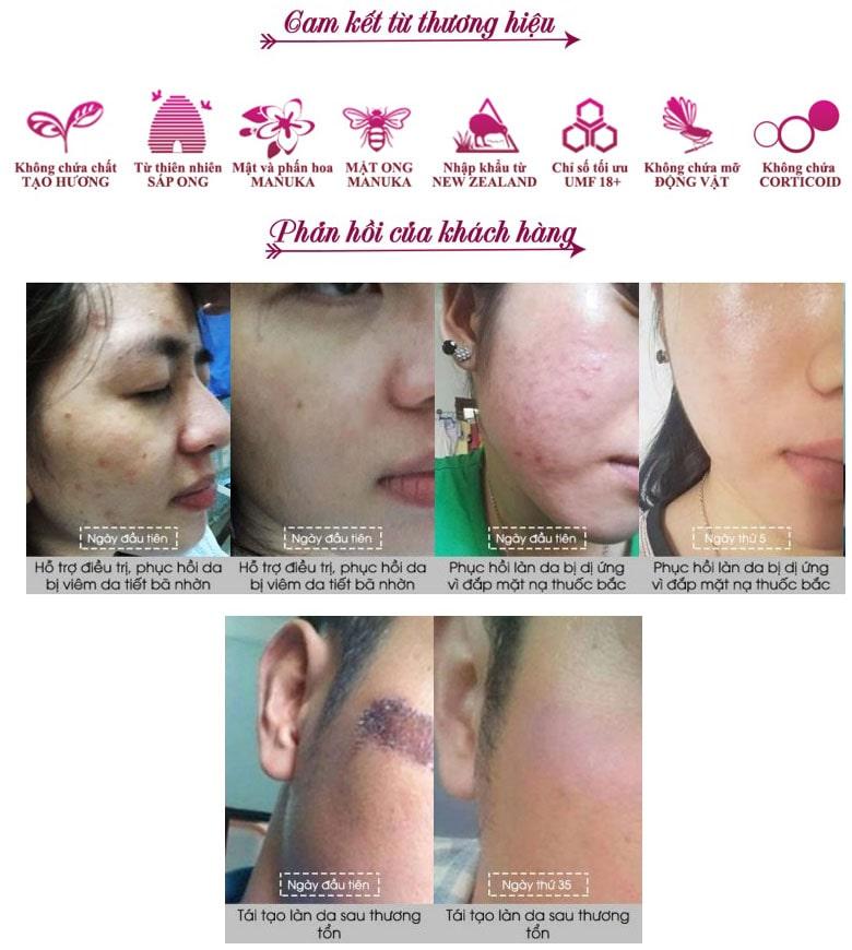 Kem Mật Ong Manuka Skin Health 18+ Madeleine Ritchie 40ml
